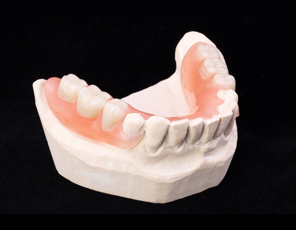 alternate angle of Partial dentures at Jasper Denture Clinic