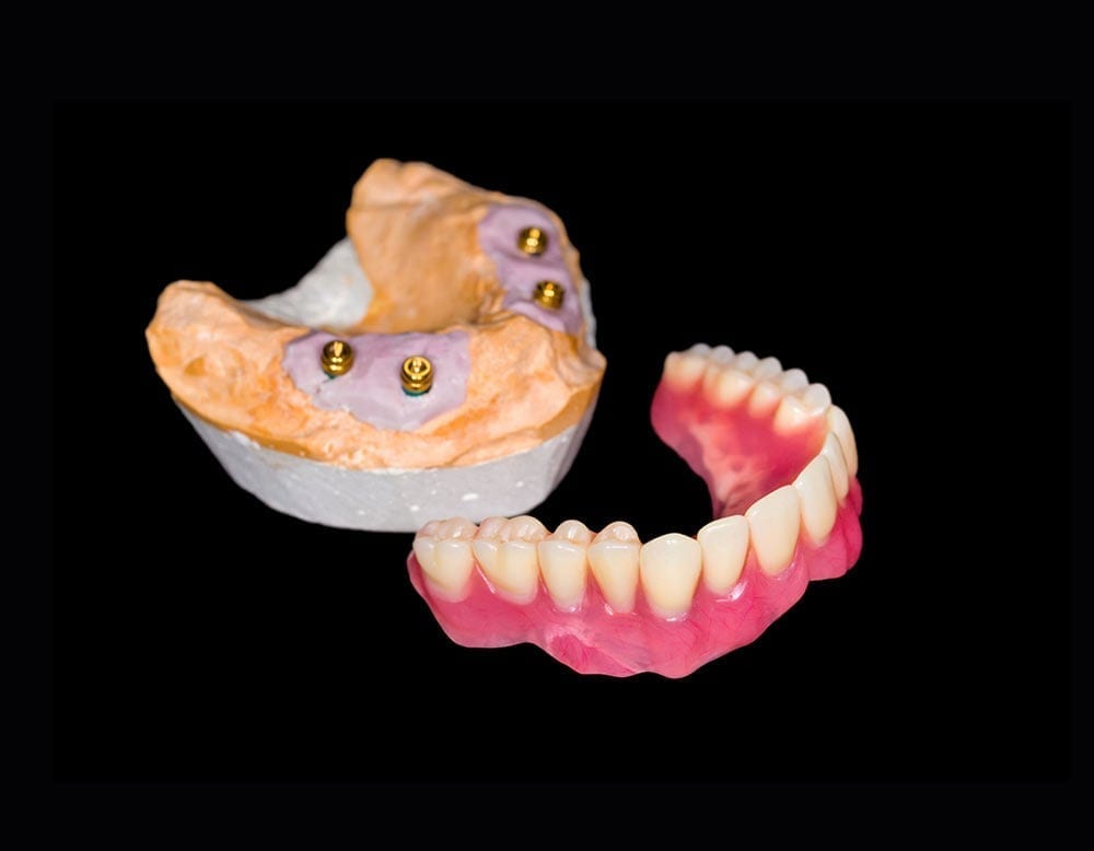 implant dentures from Jasper Denture Clinic